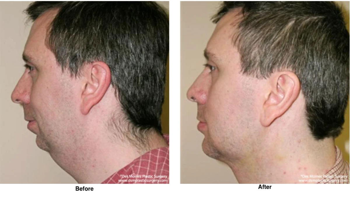 Chin Augmentation Before And After By Dr David Robbins