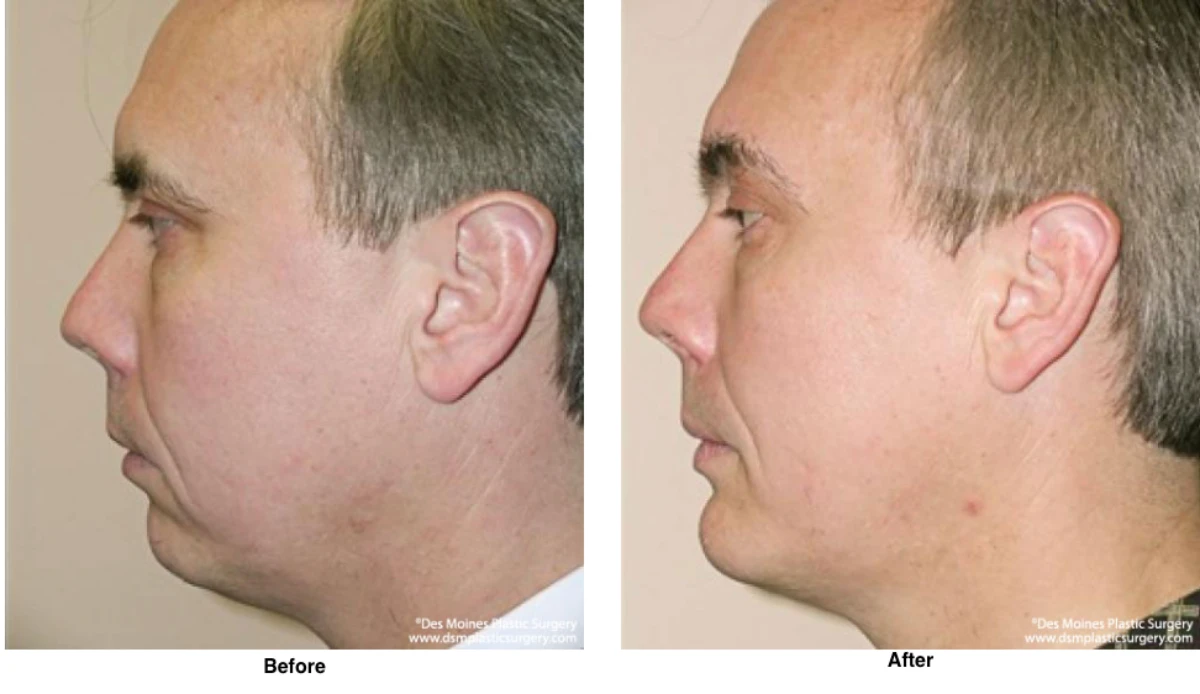 Chin Augmentation Before And After By Dr David Robbins