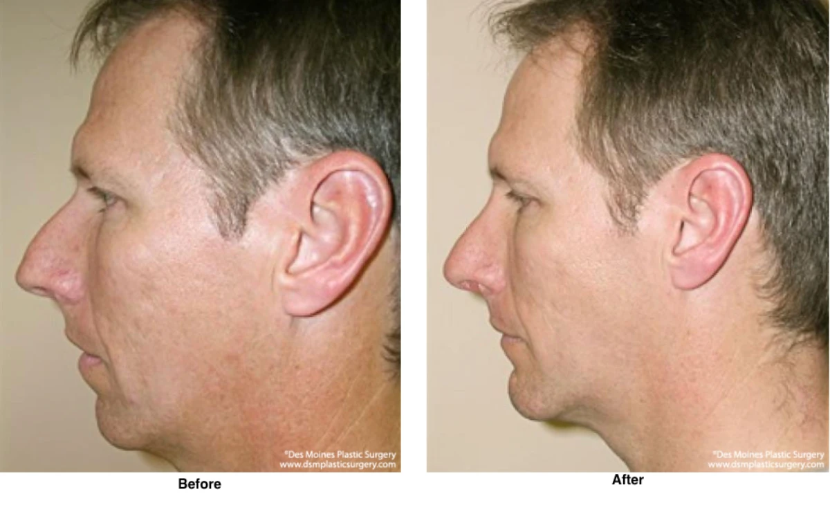 Chin Augmentation Before And After By Dr David Robbins