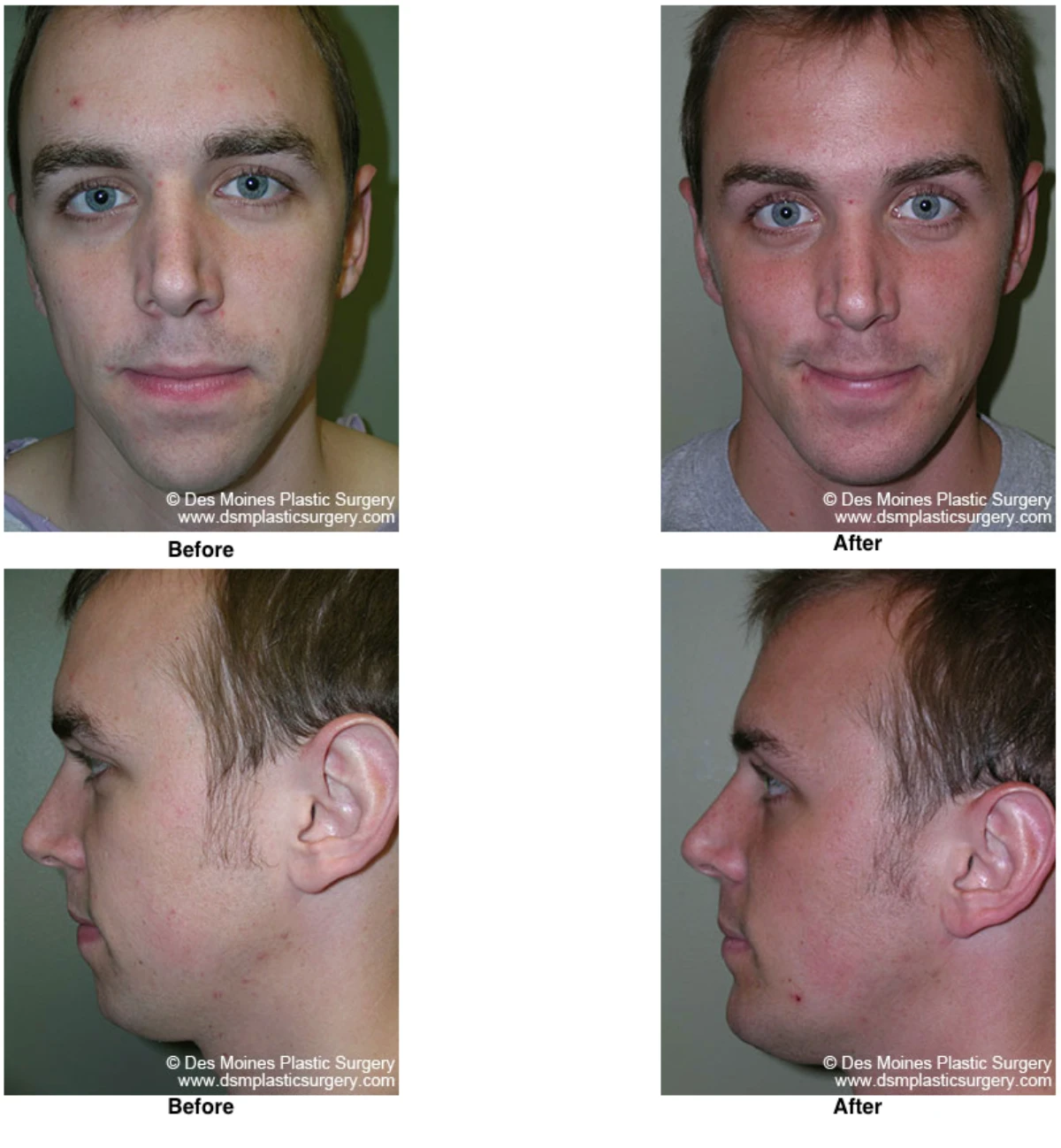 Chin Augmentation Before And After By Dr David Robbins