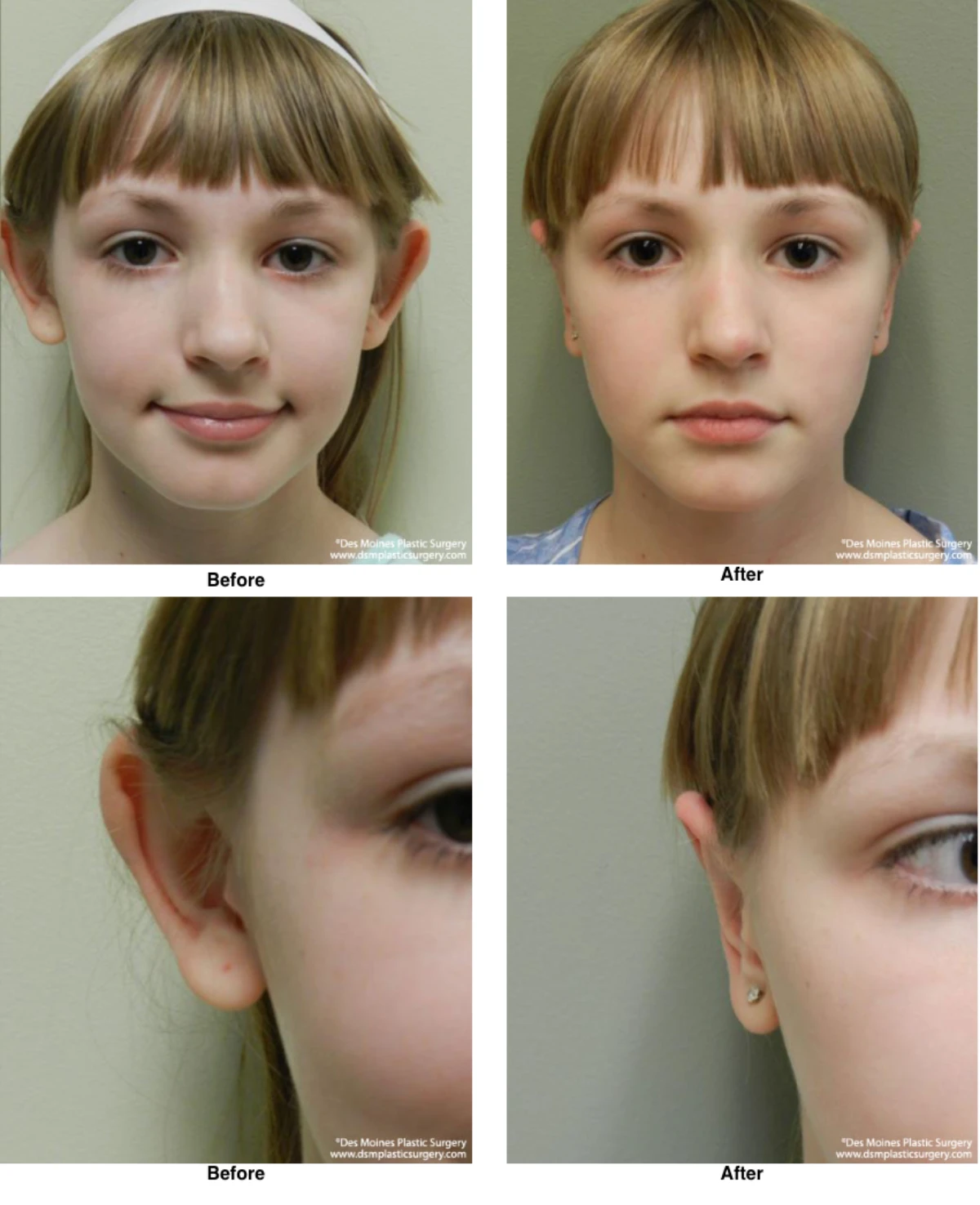 Ear Surgery Before And After By Dr David Robbins