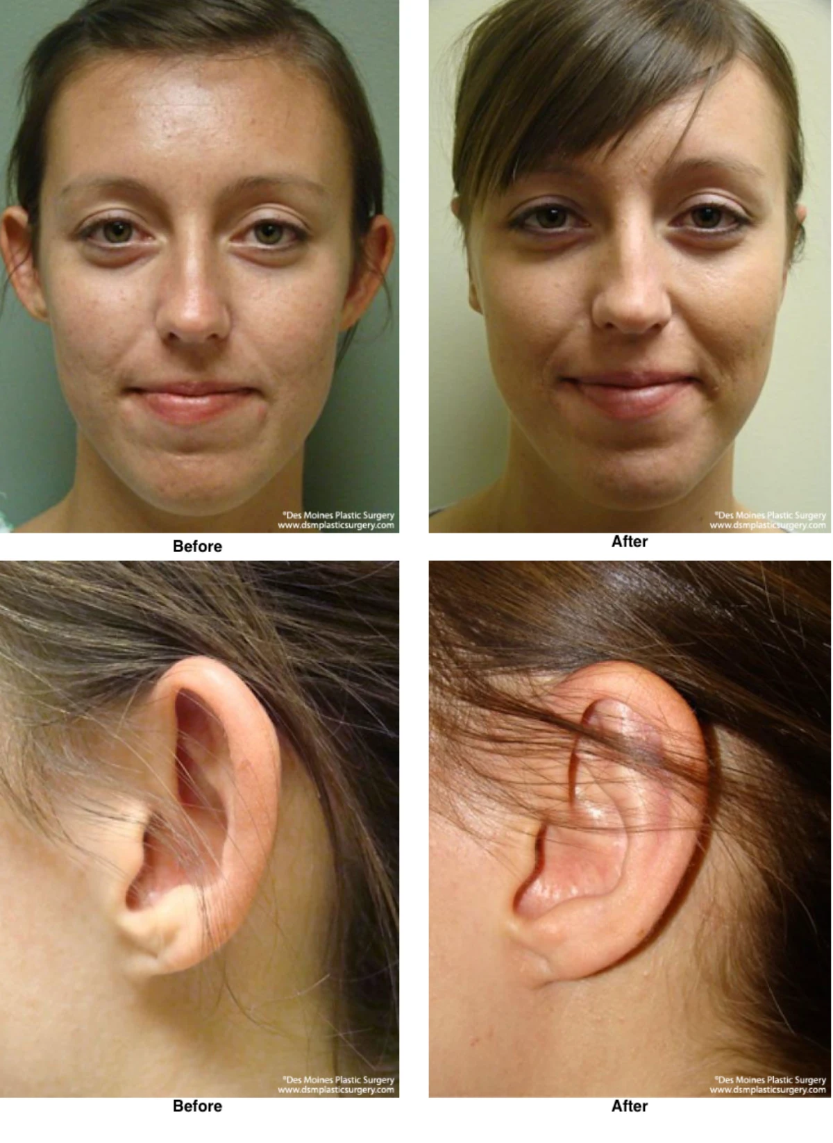 Ear Surgery Before And After By Dr David Robbins