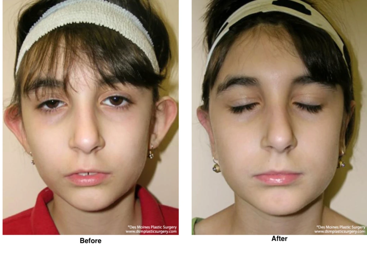 Ear Surgery Before And After By Dr David Robbins