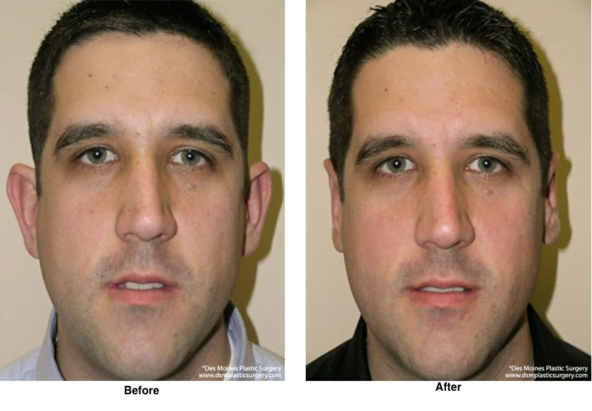 Ear Surgery Before And After By Dr David Robbins
