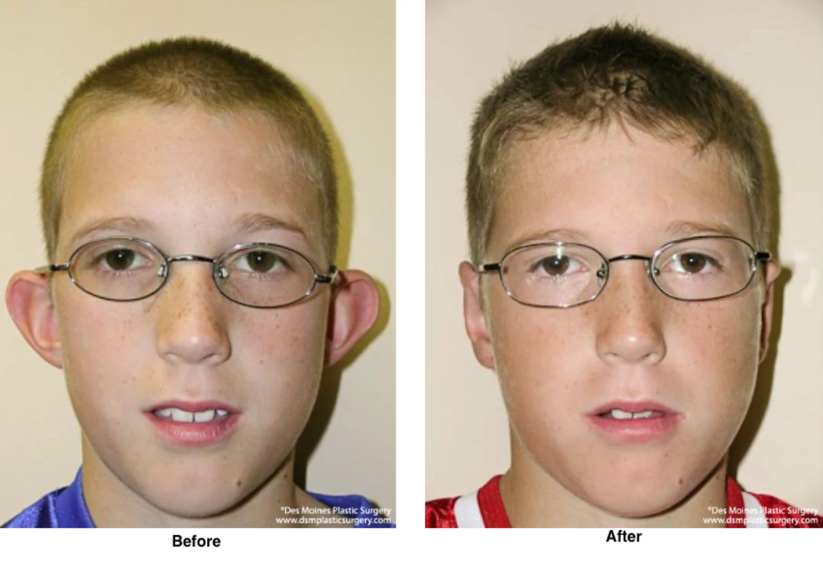 Ear Surgery Before And After By Dr David Robbins