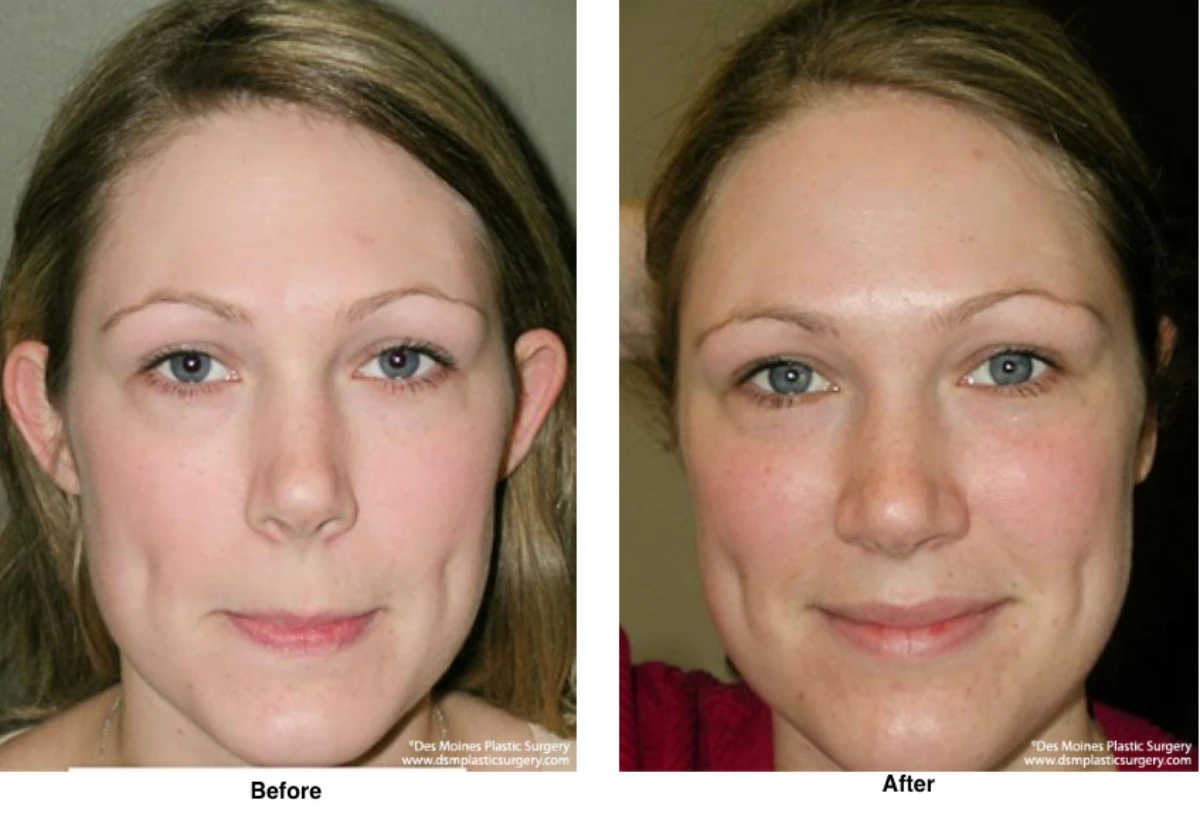 Ear Surgery Before And After By Dr David Robbins
