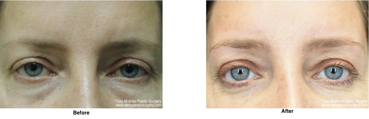 Eyelid Surgery Before And After Performed By Dr David Robbins
