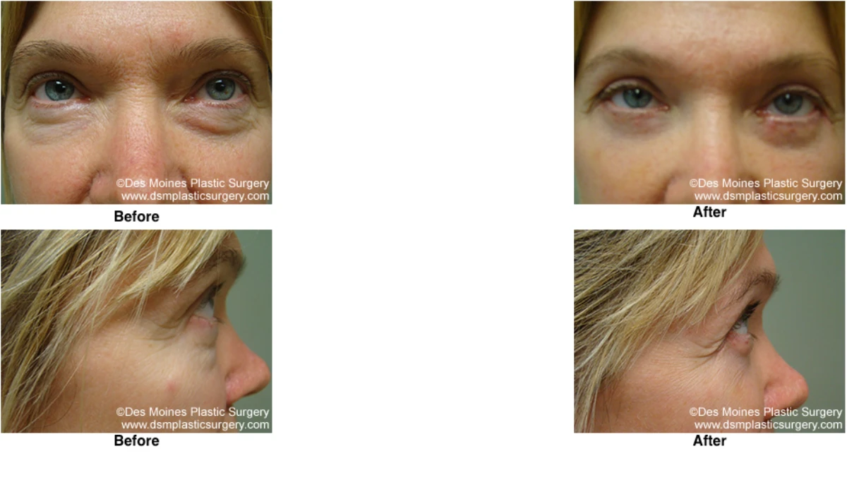 Eyelid Surgery Before And After Performed By Dr David Robbins