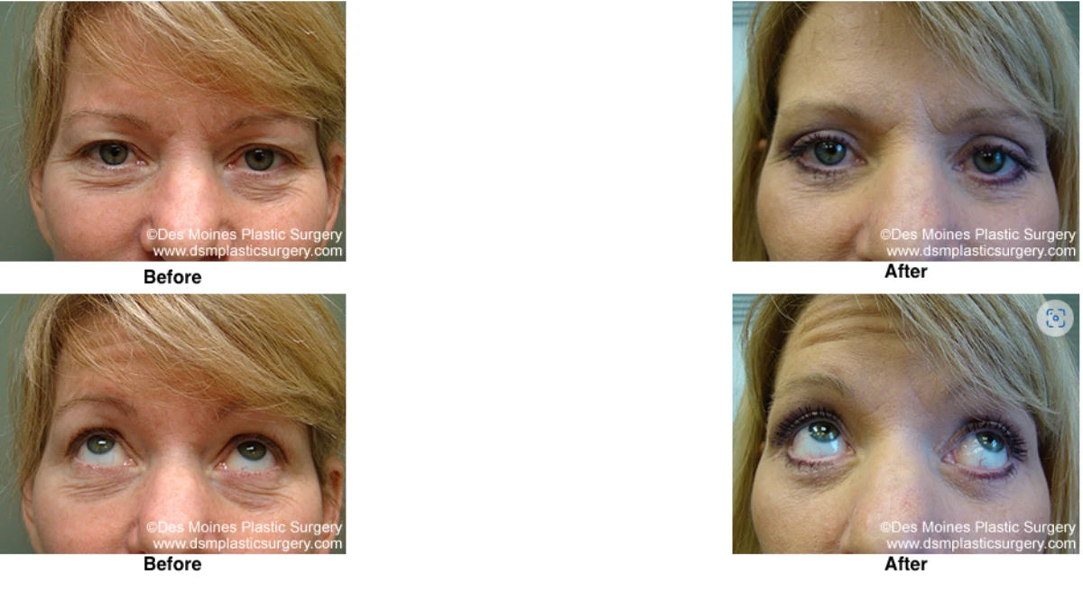 Eyelid Surgery Before And After Performed By Dr David Robbins