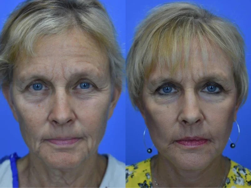 Facelift 1 Before And After Neograft