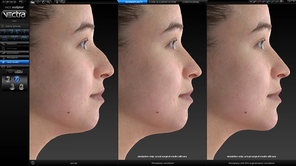 Vectra 3D Imaging 2 Facesculptor Rhino Chin Review Rgb