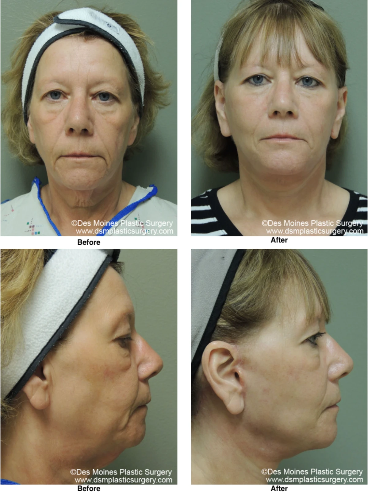 Facelift Before and After Photo by Dr David Robbins