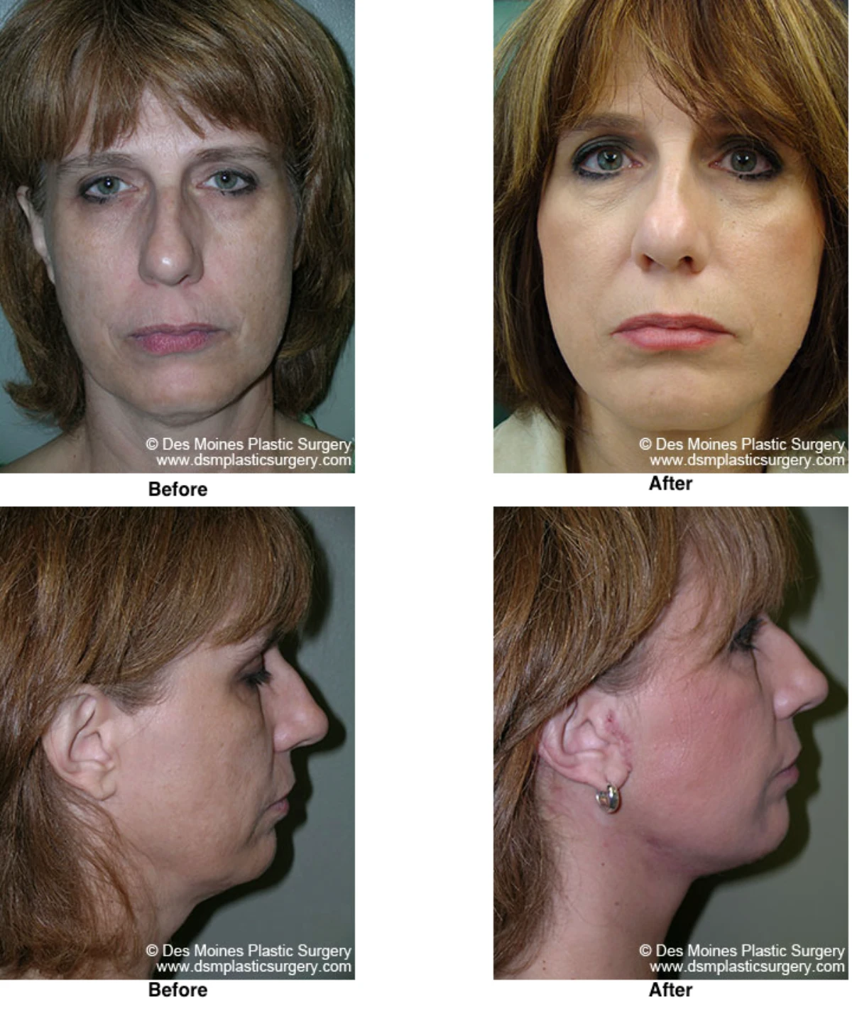 Facelift Before and After Photo by Dr David Robbins