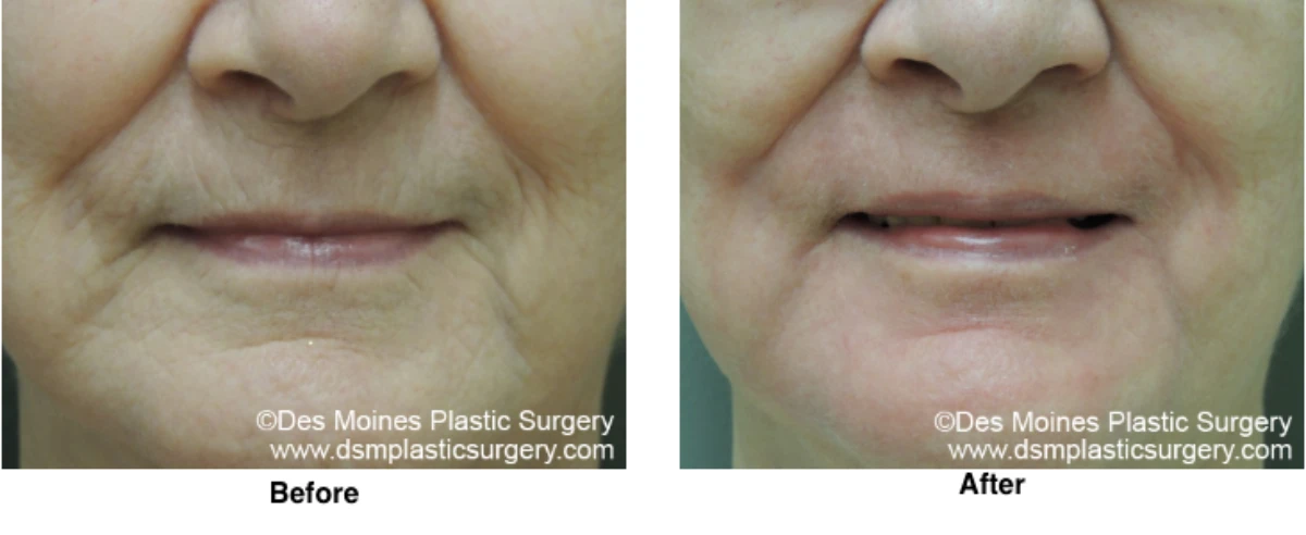 Laser Skln Resurfacing Before And After Performed By Dr David Robbins