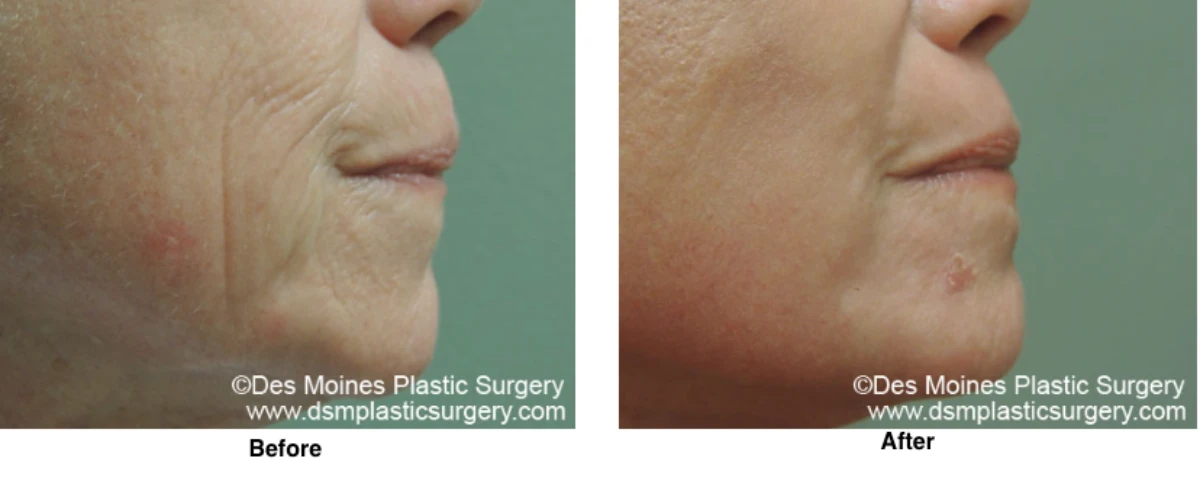 Laser Skln Resurfacing Before And After Performed By Dr David Robbins