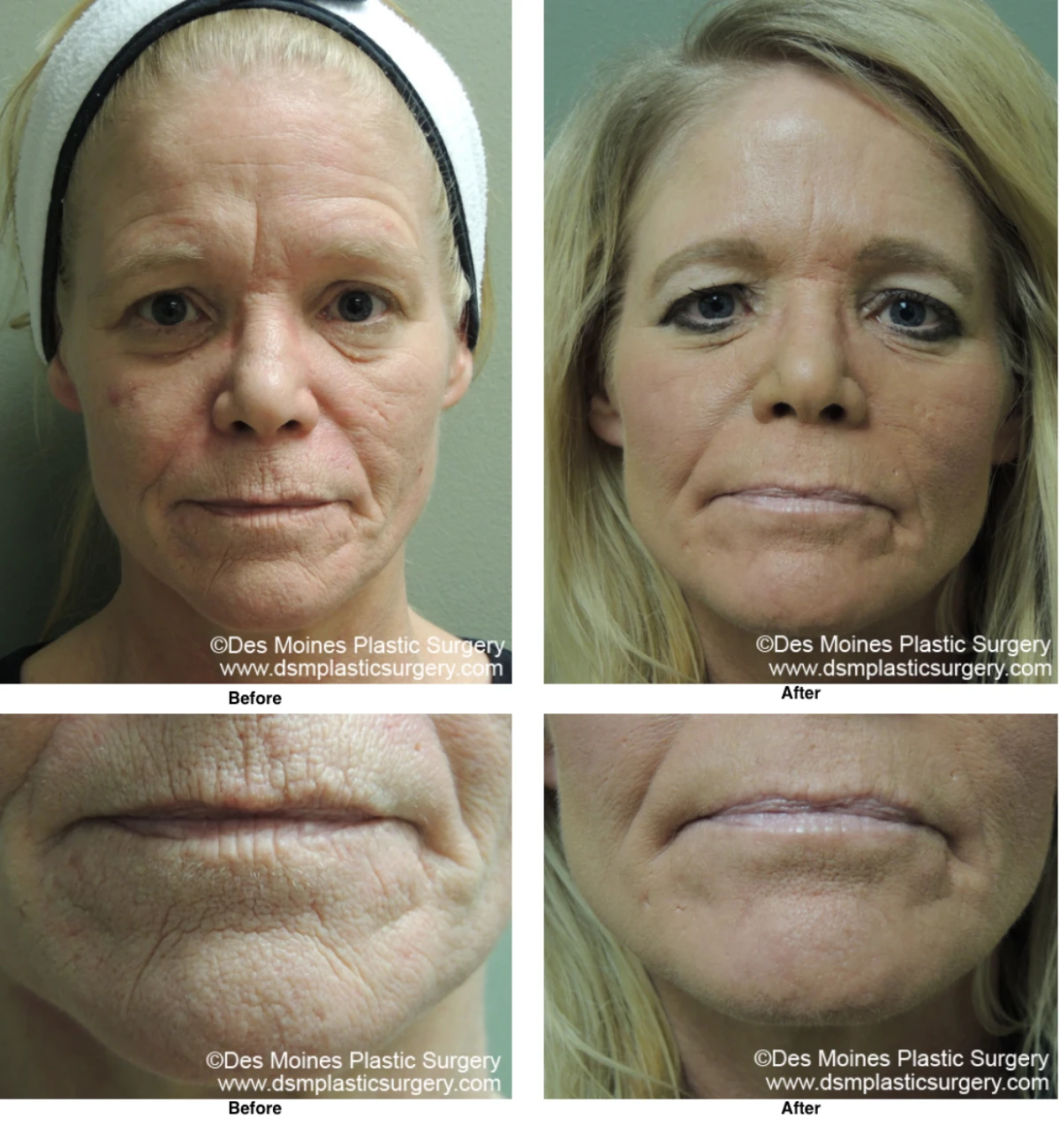 Laser Skln Resurfacing Before And After Performed By Dr David Robbins