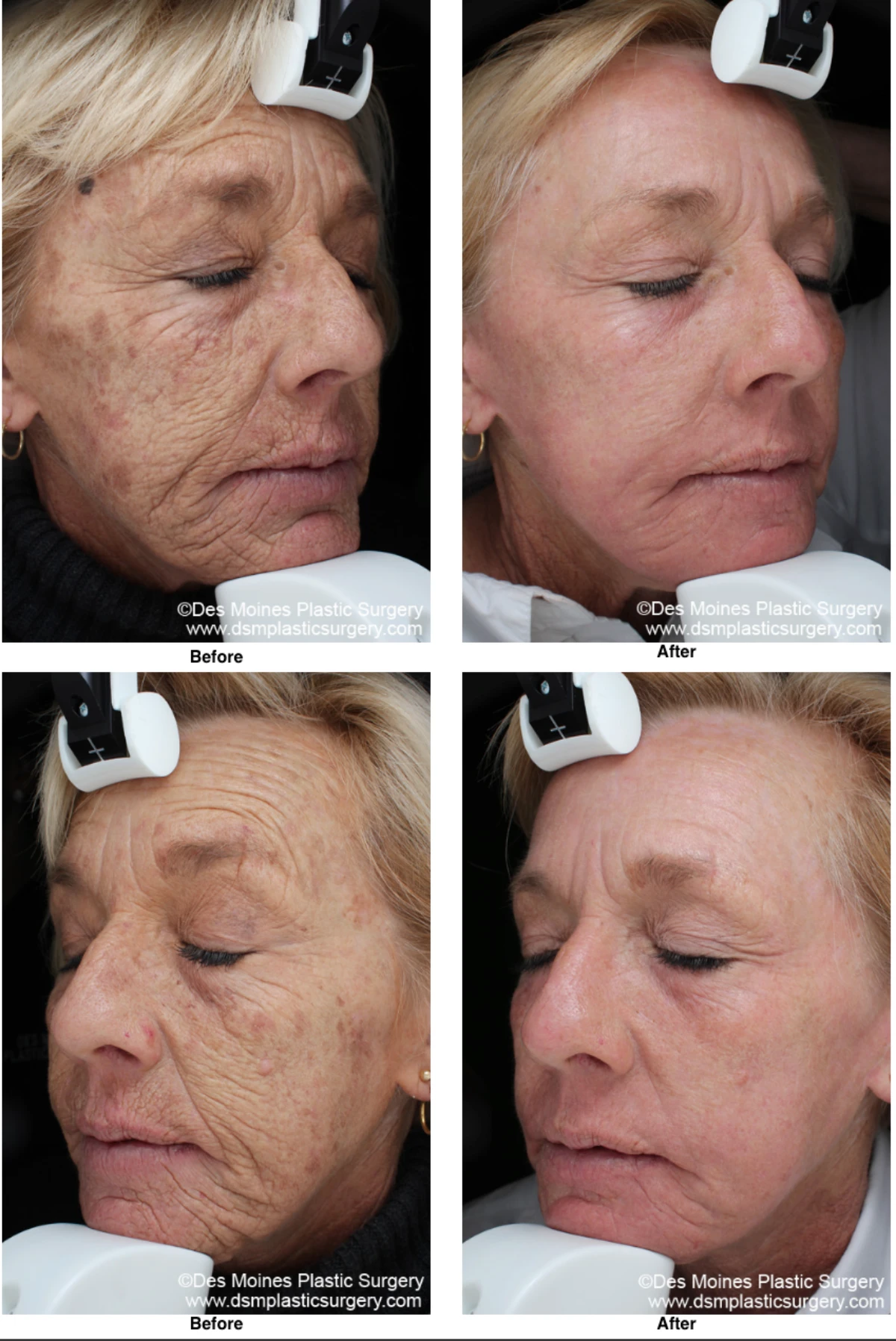 Laser Skln Resurfacing Before And After Performed By Dr David Robbins