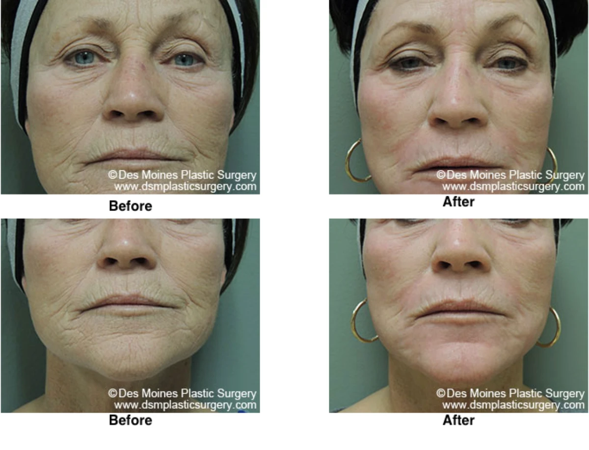 Laser Skln Resurfacing Before And After Performed By Dr David Robbins