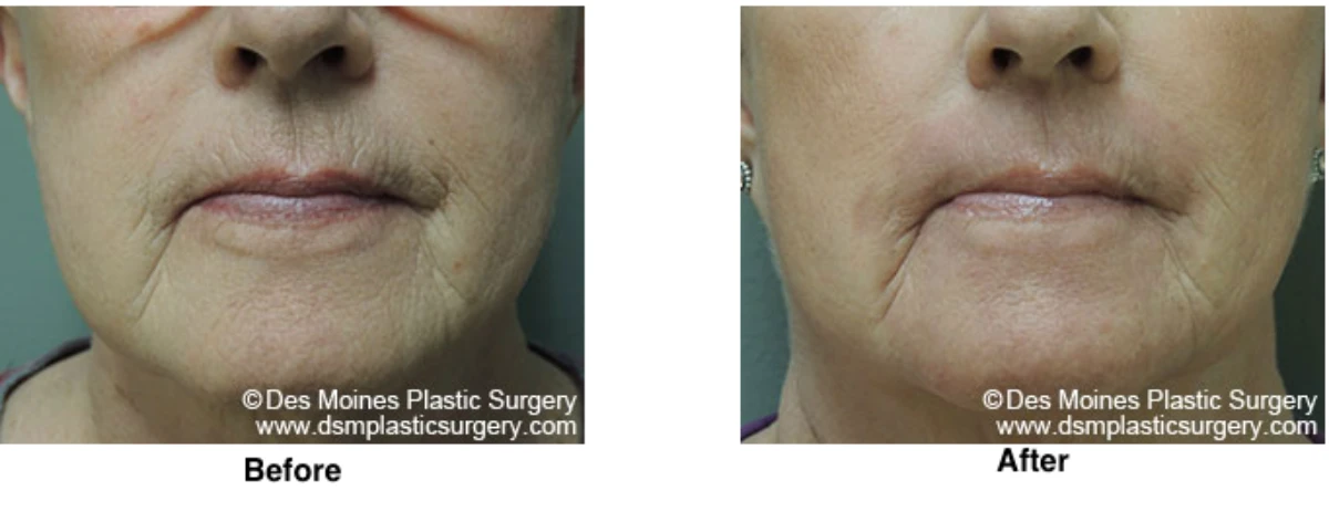 Laser Skln Resurfacing Before And After Performed By Dr David Robbins