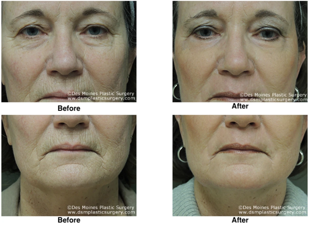 Laser Skln Resurfacing Before And After Performed By Dr David Robbins