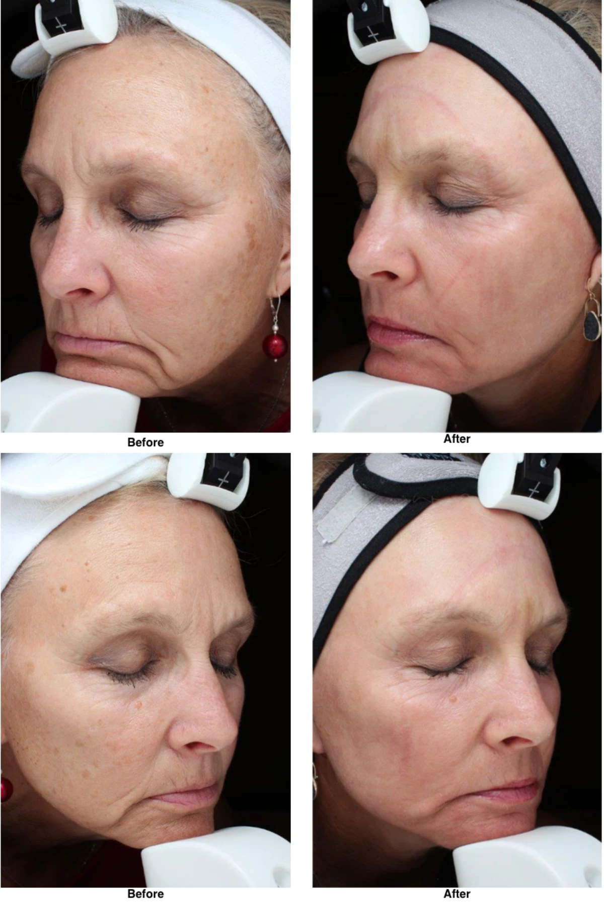 Laser Skln Resurfacing Before And After Performed By Dr David Robbins