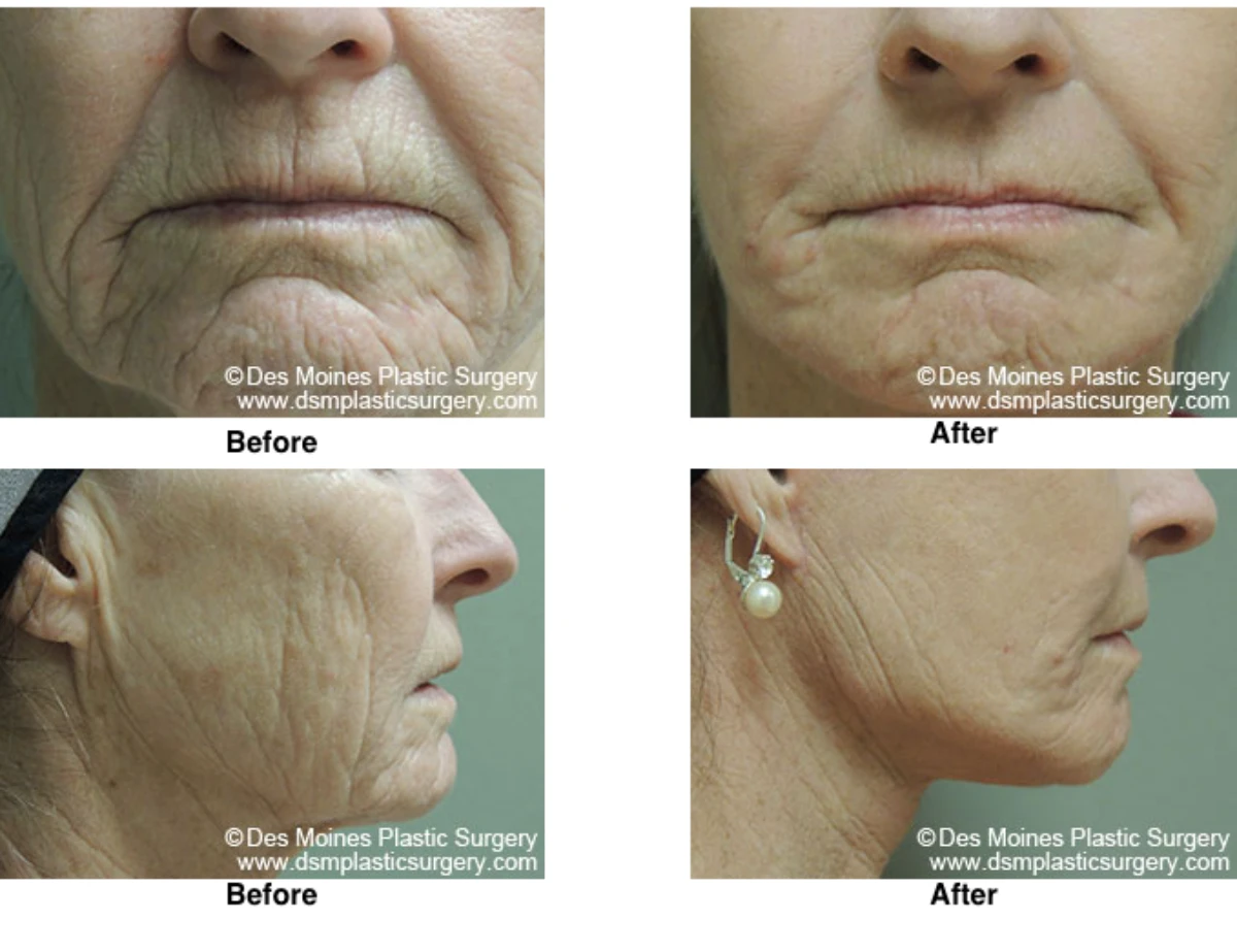 Laser Skln Resurfacing Before And After Performed By Dr David Robbins