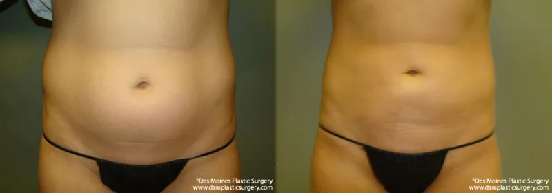 Vectra 3D Imaging 13 Before And After Neograft
