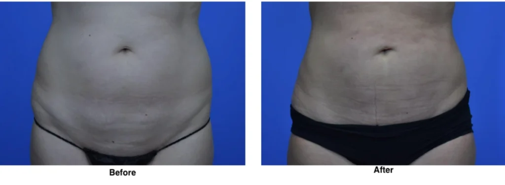Liposuction Before and After Performed by Dr David Robbins