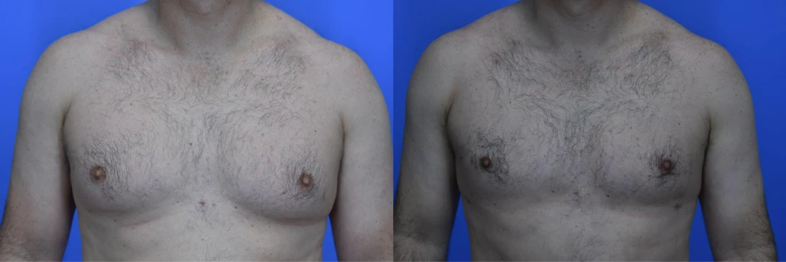 Male Cosmetic Surgery 1 Before And After Neograft