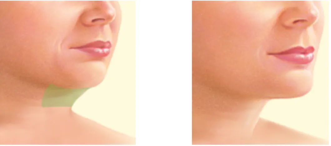 Neck Liposuction Before and After Illustration
