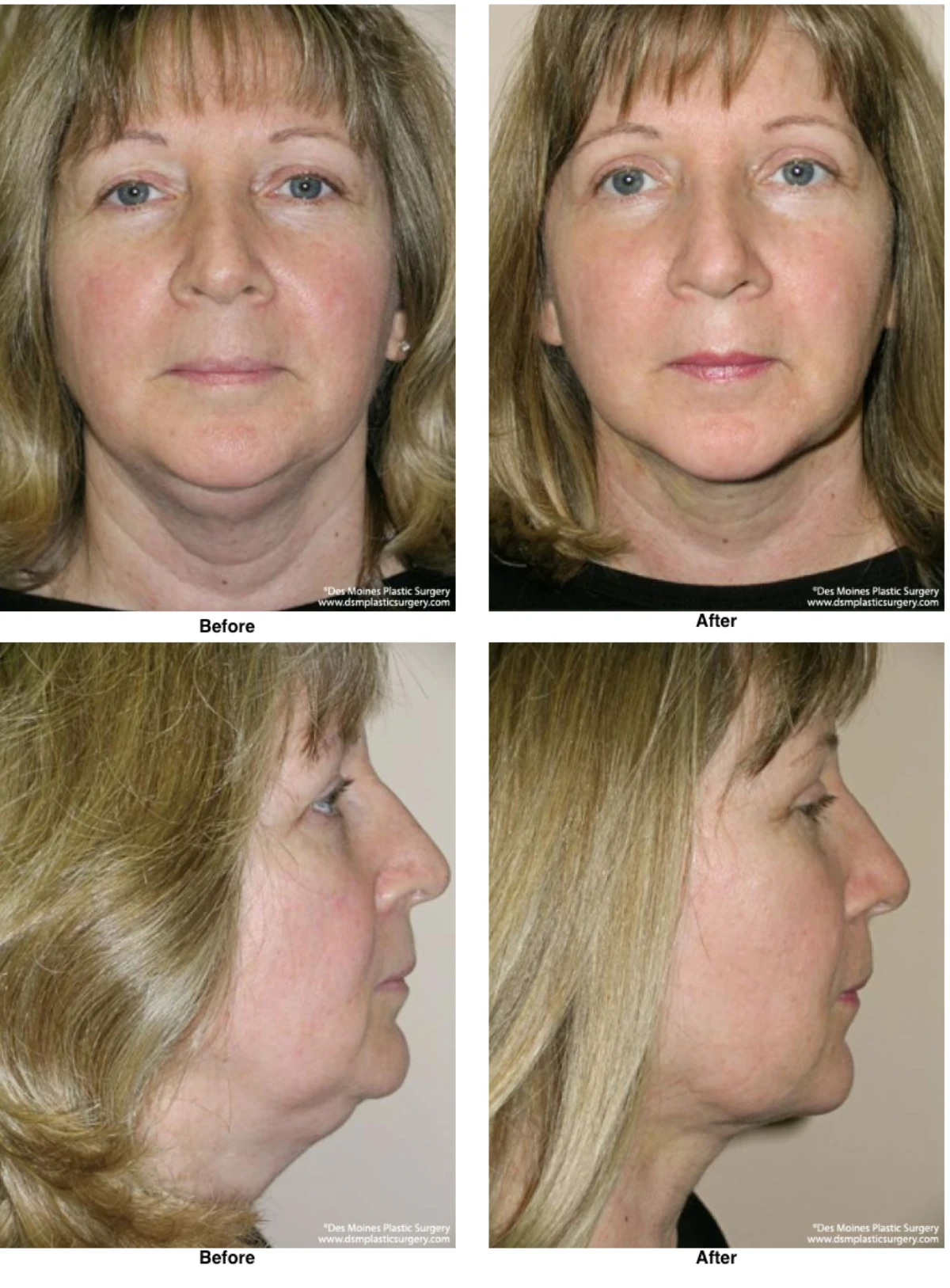 Neck Liposuction Before And After Performed By Dr David Robbins