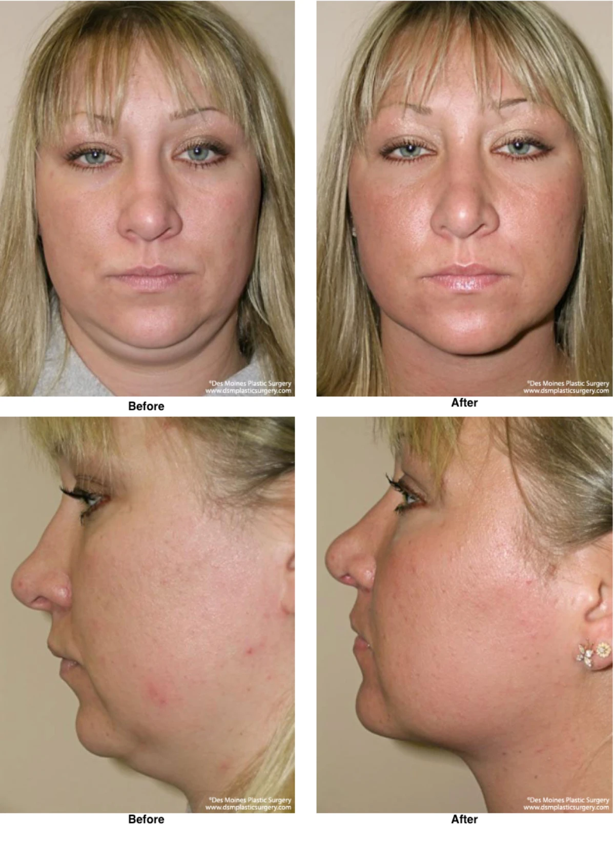 Neck Liposuction Before And After Performed By Dr David Robbins