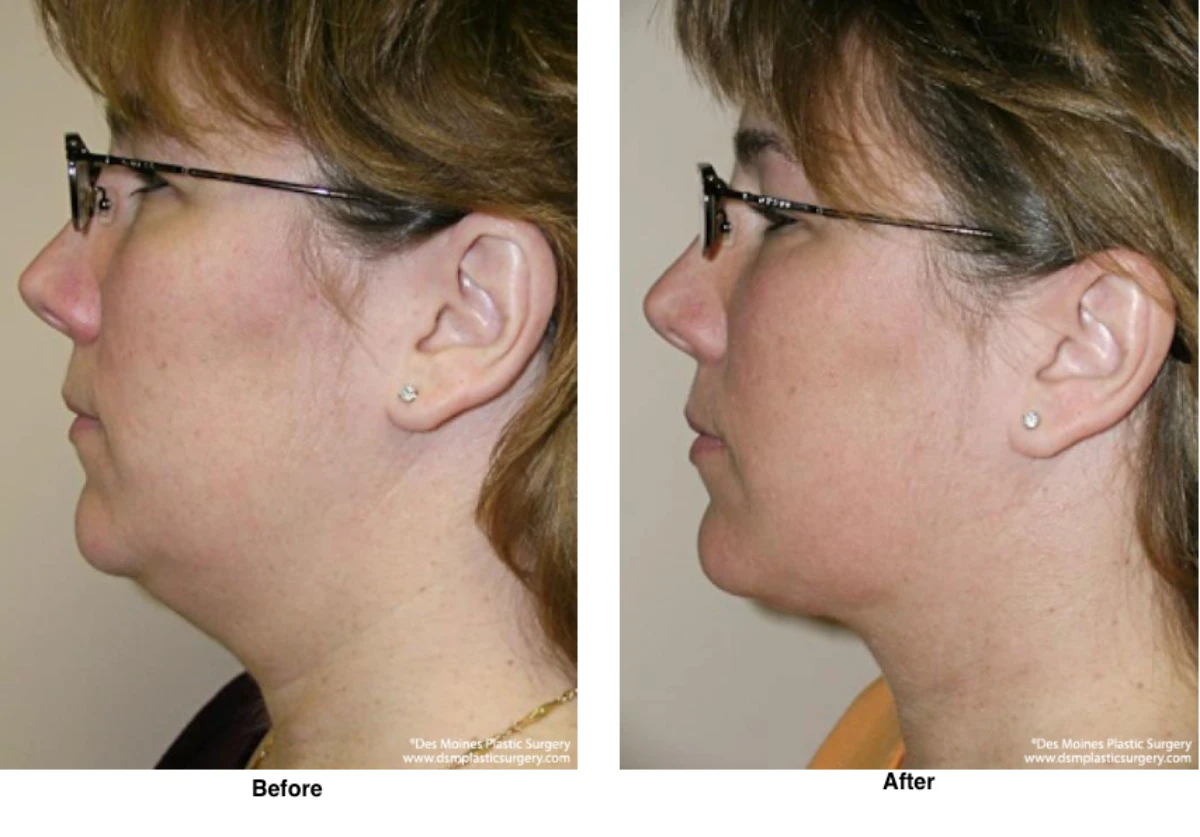 Neck Liposuction Before And After Performed By Dr David Robbins