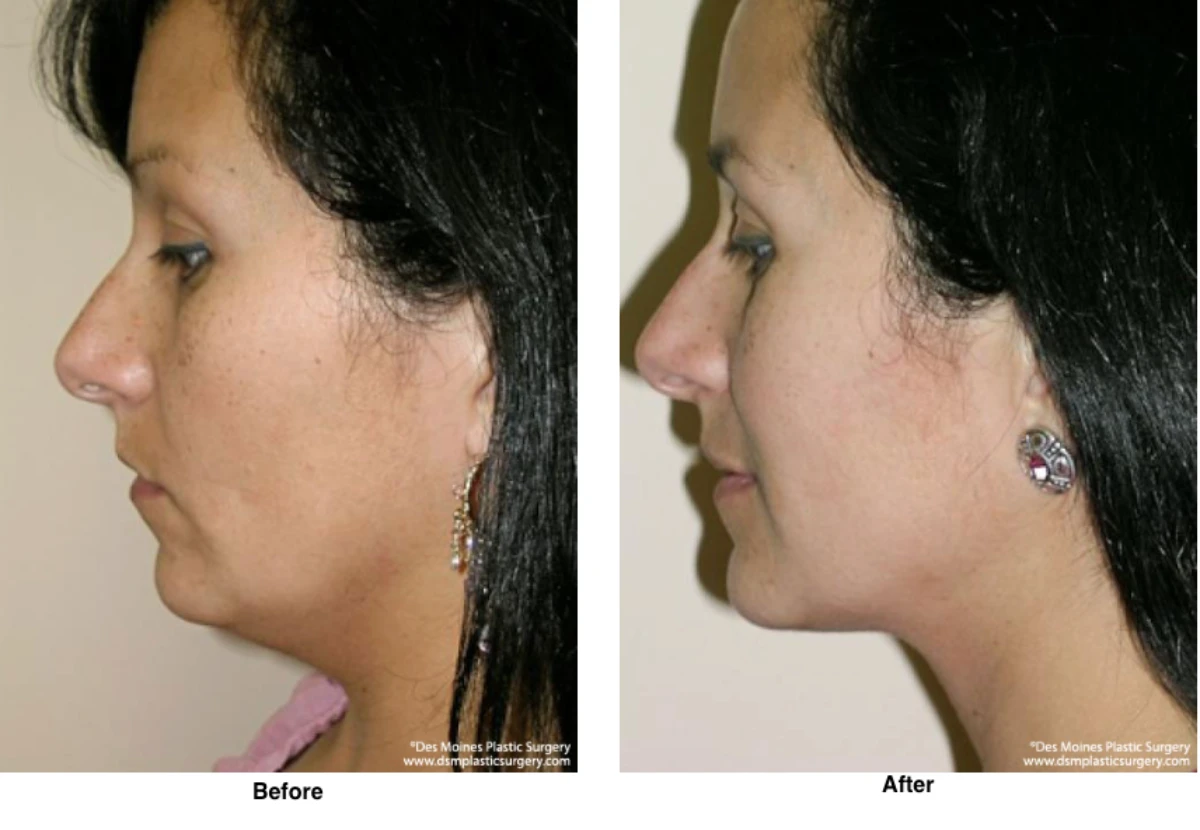 Neck Liposuction Before And After Performed By Dr David Robbins