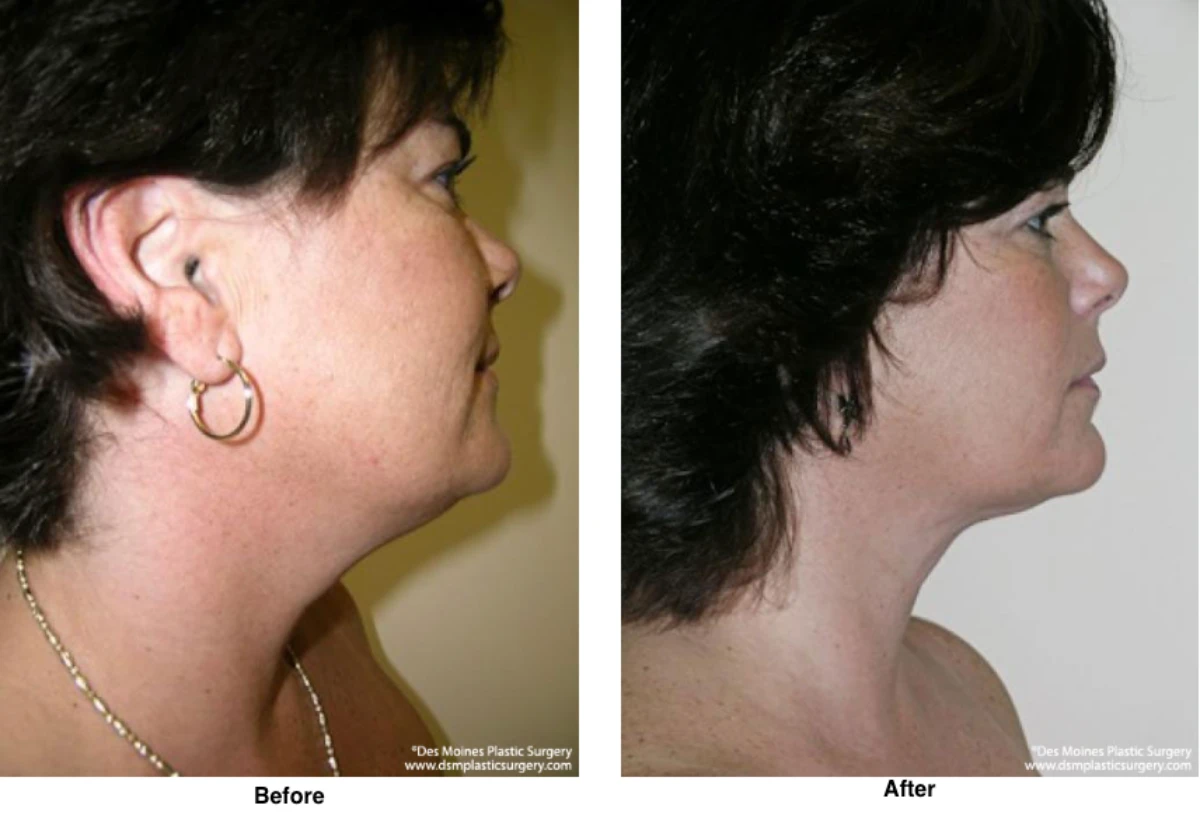 Neck Liposuction Before And After Performed By Dr David Robbins