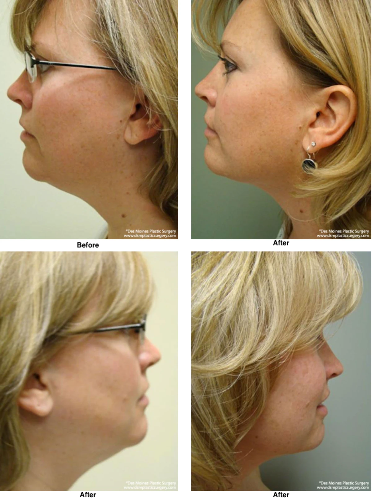 Neck Liposuction Before And After Performed By Dr David Robbins