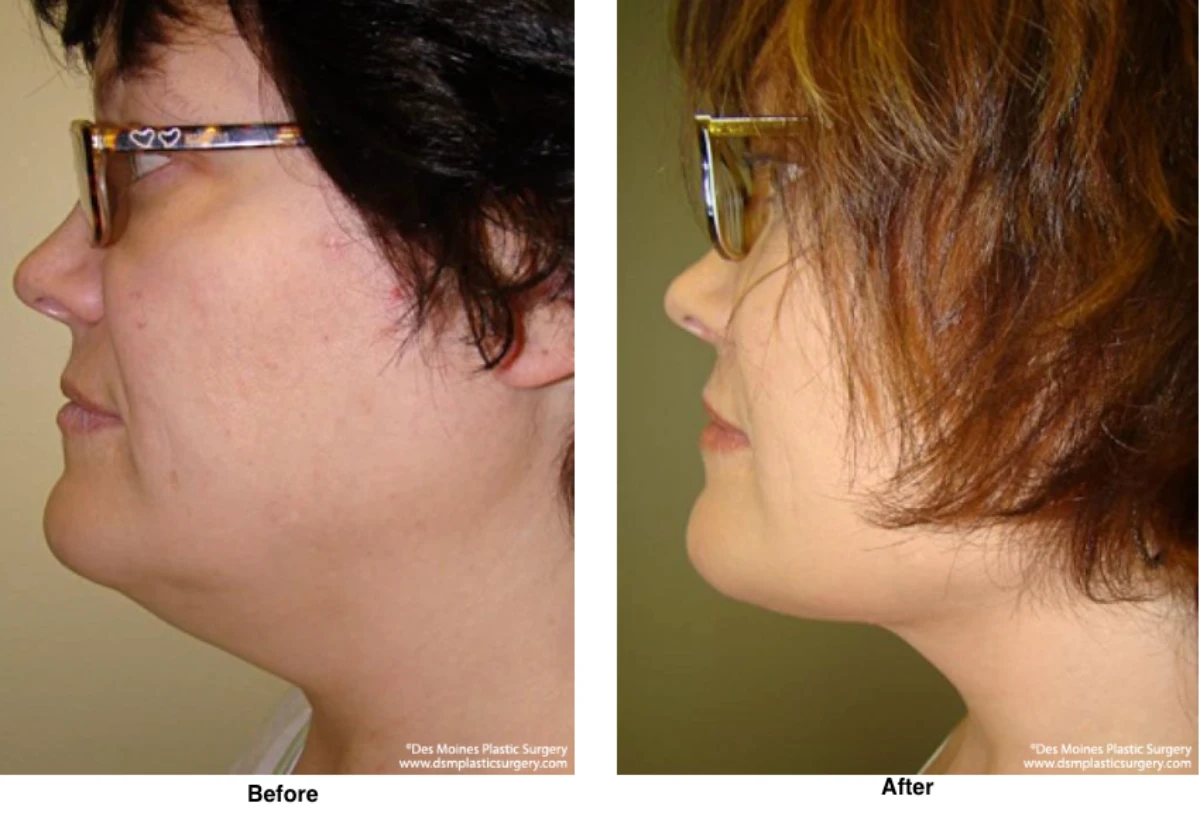 Neck Liposuction Before And After Performed By Dr David Robbins
