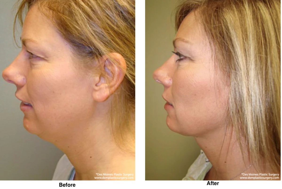 Neck Liposuction Before And After Performed By Dr David Robbins