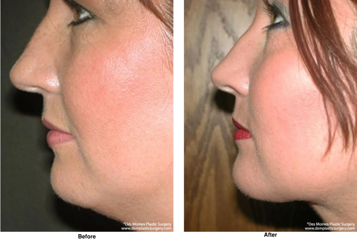 Neck Liposuction Before And After Performed By Dr David Robbins