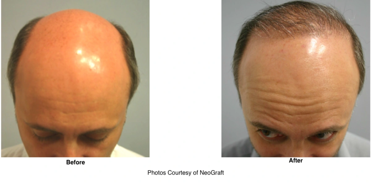 Neograft Hair Loss Replacement Before And After