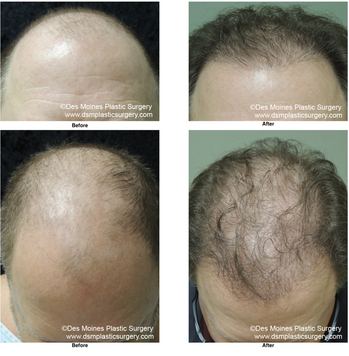 Neograft Hair Loss Replacement Before And After