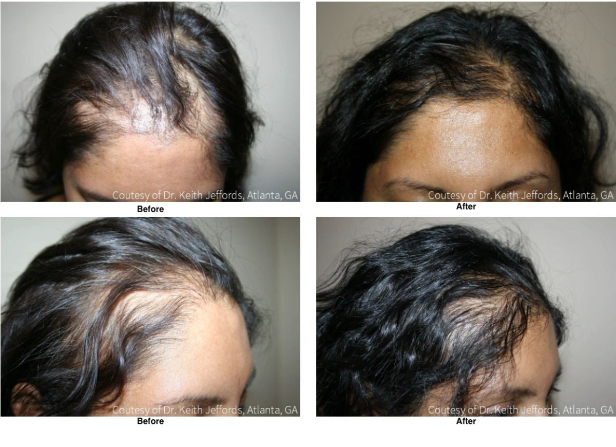 Neograft Hair Loss Replacement Before And After
