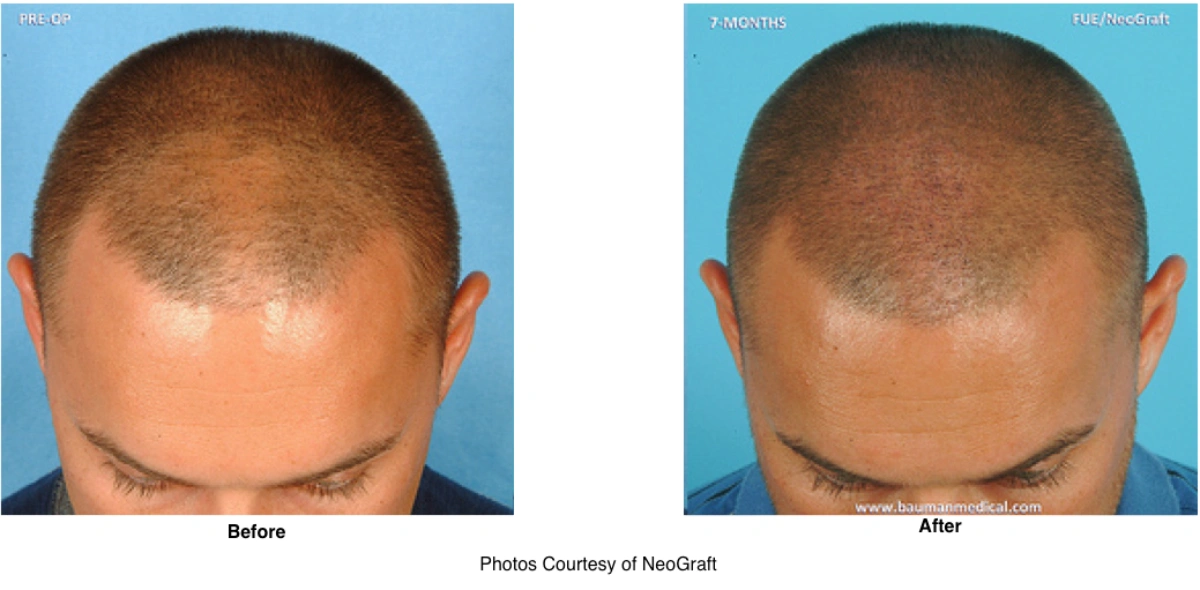 Neograft Hair Loss Replacement Before And After