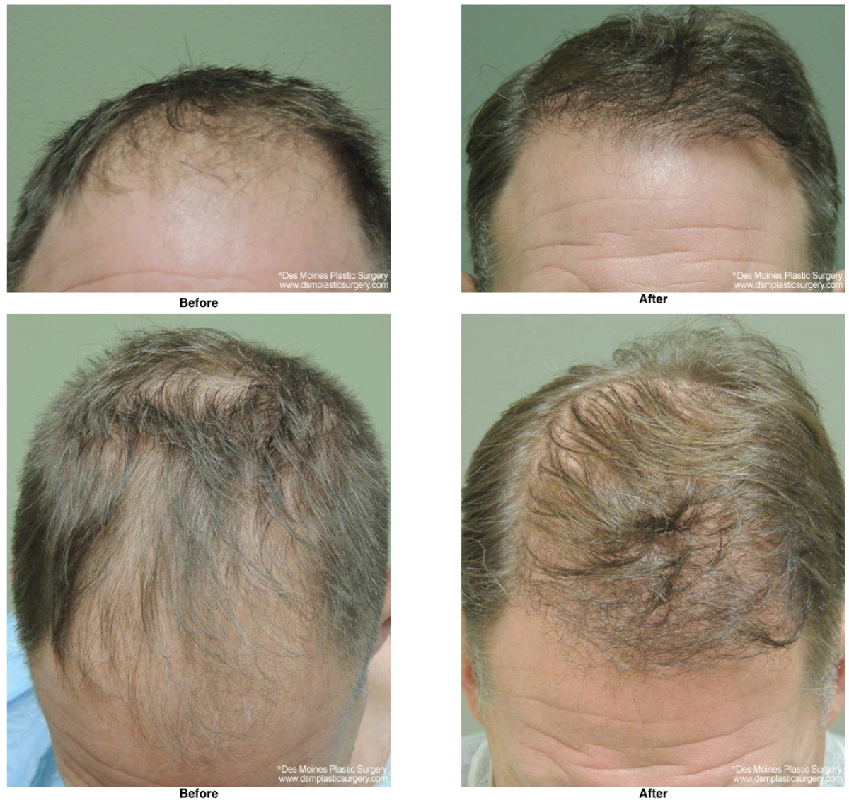 Neograft Hair Loss Replacement Before And After