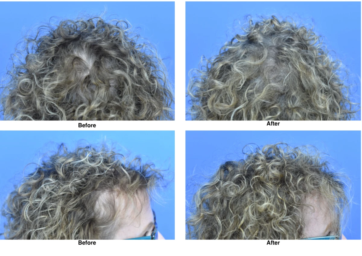 PRP Hair Loss Replacement Before and After by Dr David Robbins