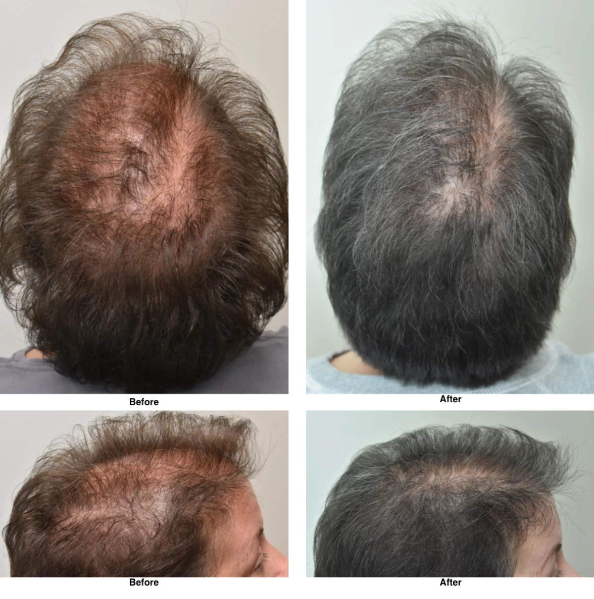 PRP Hair Loss Replacement Before and After by Dr David Robbins