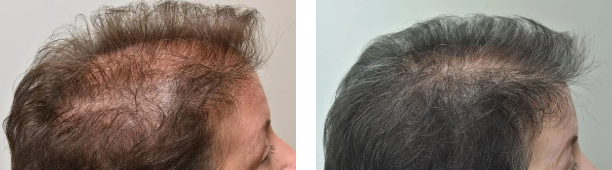 Prf Hair Loss Replacement 1 Prp Hair Restoration Before And After Photo Performed By Dr David Robbins