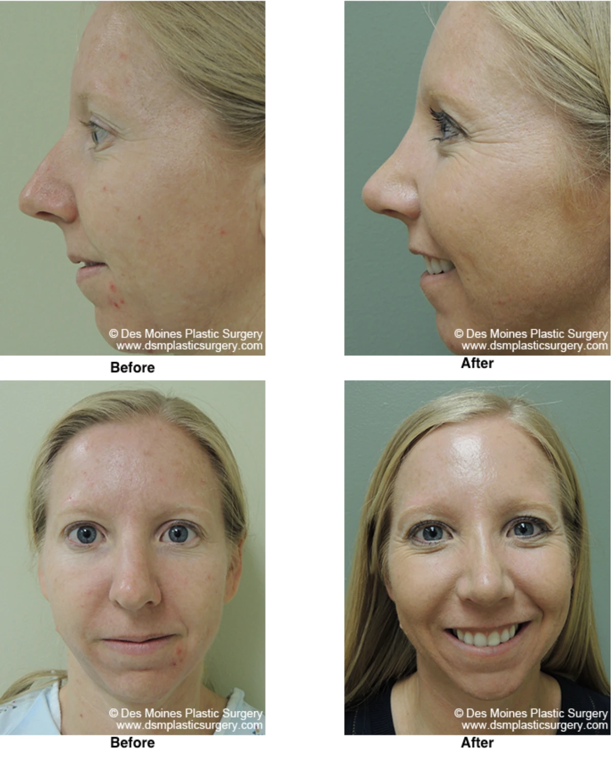 Rhinoplasty Before and After Performed by Dr David Robbins