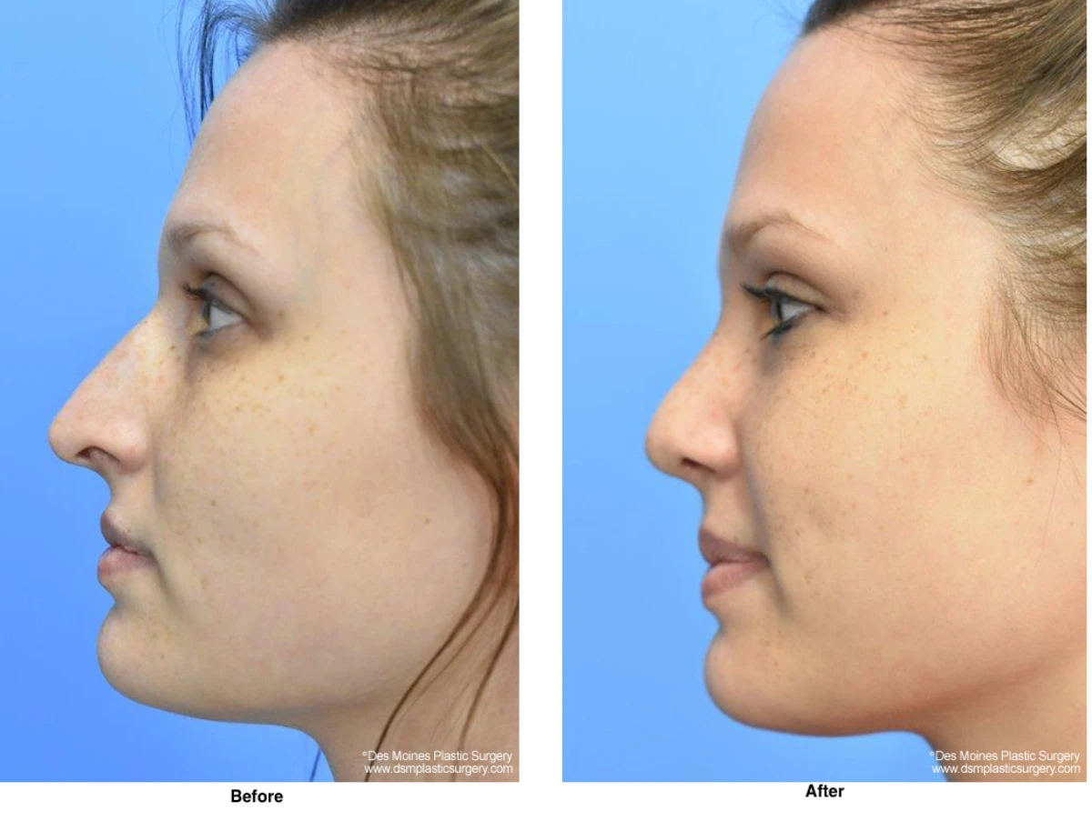 Rhinoplasty Before and After Performed by Dr David Robbins