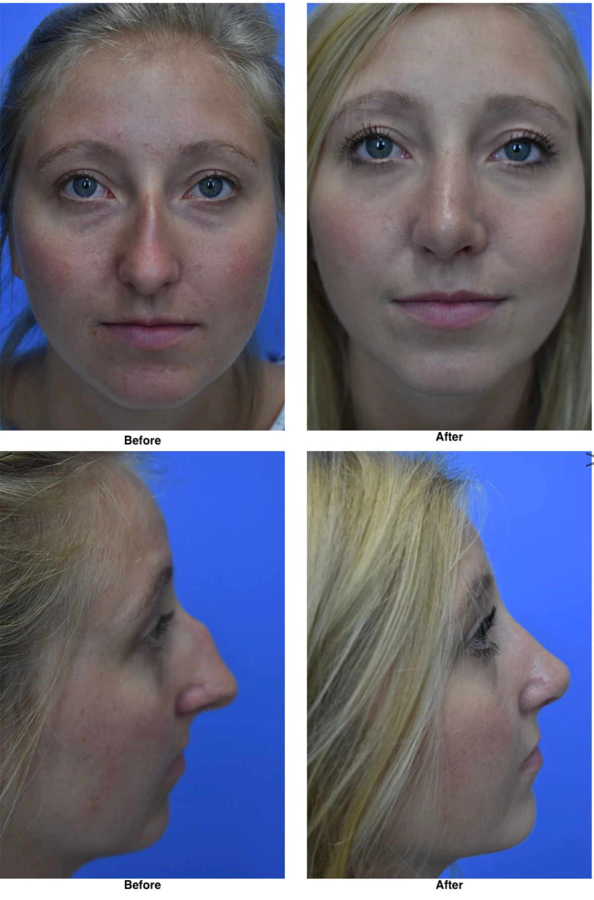 Rhinoplasty Before and After Performed by Dr David Robbins